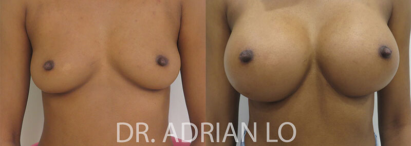 Breast Augmentation